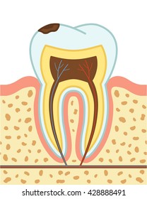 Tooth decay. First stage - enamel decay. Vector illustration