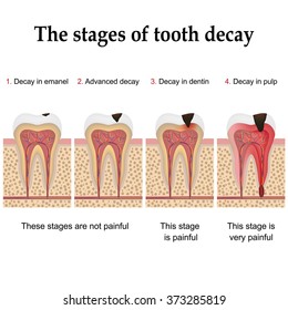 Tooth Decay Formation Step By Step, Forming Dental Plaque And Finally Caries And Cavity