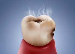 Tooth Decay And Infection Are The Causes Of Bad Breath. Realistic Vector Illustration File.