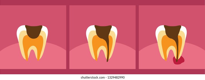 Tooth decay on a pink background. Vector illustration.