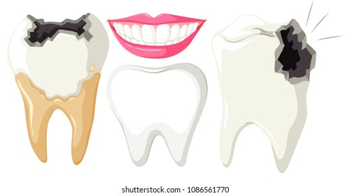 Tooth Decay On White Background Illustration