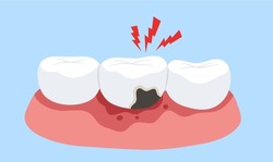 Tooth Decay With Pain On Red Pain Gum. Concept Of Tooth Cavity, Toothache, Dental Care, Dentistry, Oral Health, Dentist, Mouth, Tooth Caries. Flat Vector Illustration. 