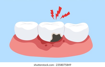 Tooth decay with pain on red pain gum. Concept of tooth cavity, toothache, dental care, dentistry, oral health, dentist, mouth, tooth caries. Flat vector illustration. 