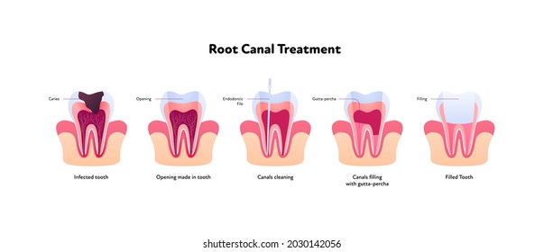 Tooth decay and root canal treatment chart. Vector biomedical illustration. Cross section. Teeth in gum feeling steps isolated on white background. Design for dental oral healthcare, dentistry