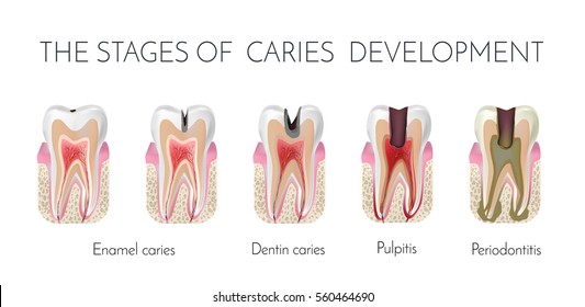 Tooth decay. The stages of caries development. Enamel and dentin caries, pulpits and periodontitis medical vector illustration