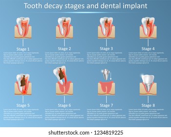 Tooth decay stages and dental implant. Vector illustration. Dental medicine and replacement concept. Training medical anatomical poster.