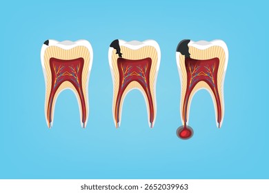 Tooth decay stages showing progression of cavities. Great for dental care, oral hygiene, and education content.