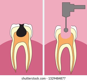 Tooth decay and its treatment. Vector illustration.