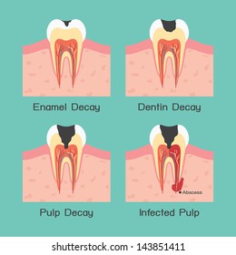 Tooth decay, vector