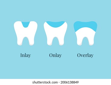 Tooth Dental Ceramic Inlay, Onlay, Overlay Or Crown Treatment Set. Teeth Dentistry Restoration With Porcelain Sealant In Cavity. Vector Flat Design Cartoon Style Clip Art Illustration.