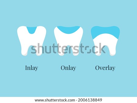 Tooth dental ceramic inlay, onlay, overlay or crown treatment set. Teeth dentistry restoration with porcelain sealant in cavity. Vector flat design cartoon style clip art illustration.