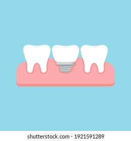 Tooth and dental implant in gum isolated on blue background. Healthy human teeth and implant prosthesis concept. Flat design cartoon style vector orthodontist 
dentistry illustration.