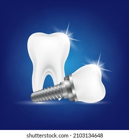 Tooth and dental implant for stomatology set. Implant structure models. Screw denture orthodontic implantation. stomatology clinic concept. Realistic isolated 3D vector ​illustration.