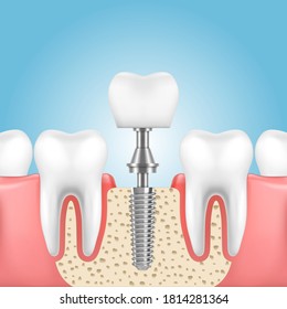 Tooth dental implant, vector dentistry, dentist and denture technologies. Human jaw with health teeth and prosthesis with implant crown, screw and abutment, dental medicine themes