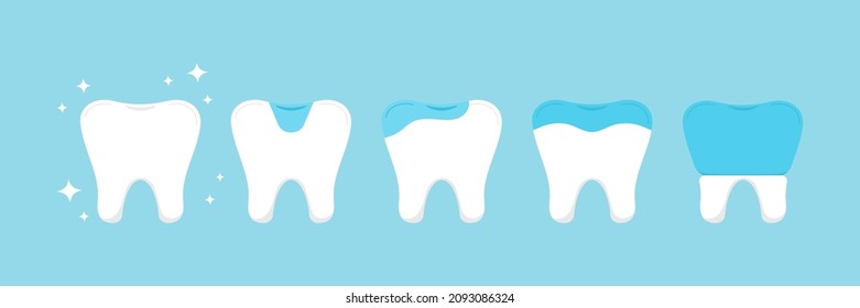 Tooth Dental Inlay, Onlay, Overlay And Crown Treatment Set. Teeth Dentistry Restoration With Ceramic Porcelain Sealant In Cavity. Vector Flat Design Cartoon Clip Art Illustration.