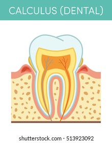 Tooth diseases: dental calculus. Vector cartoon illustration of molar affected by tartar