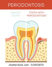 Tooth diseases: periodontosis. Vector cartoon illustration of healthy and affected molar