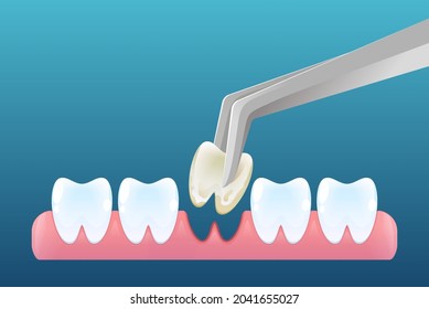 Tooth extraction concept in cartoon style. Teeth removal. Vector design 