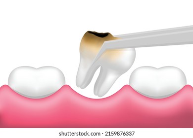 Tooth extraction with dental tools in mouth isolated on white background