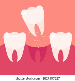 Tooth extraction, denture flat cartoon illustration. Wisdom tooth removal medical banner. Dentistry, orthodontist design background.