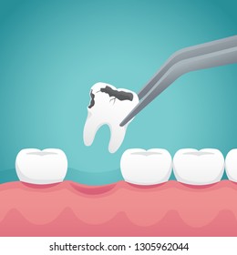 Tooth extraction illustration