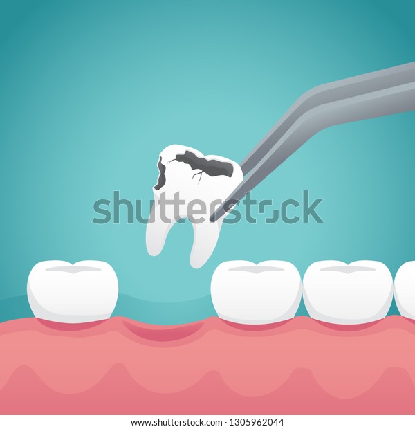 Tooth extraction\
illustration