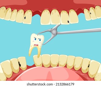 Tooth Extraction Inside Human Mouth Illustration