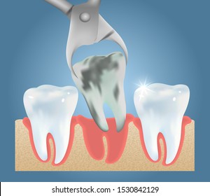 Tooth extraction vector medical education anatomy poster template. Tooth removal procedure, dental surgery concept.