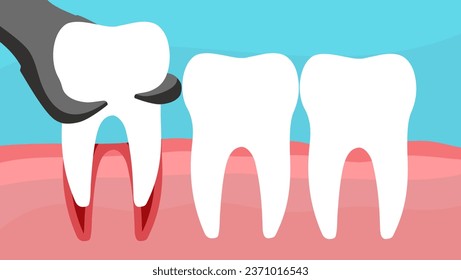 tooth extraction, A vector stock illustration