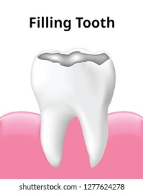 Tooth Filling with gum, isolated on white background, Realistic design illustration Vector.
