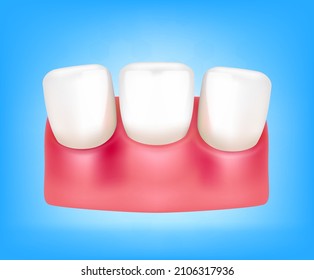 Tooth and gum inflammation dental oral problem. Gum disease, Teeth isolated on a blue background. Realistic 3D vector illustration. Dental care health and medical concept.