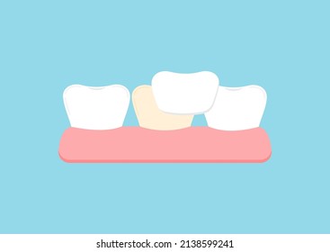 Tooth health and tooth with orthodontic veneer icon. Teeth aesthetic treatment, cleaning, ceramic crown color restoration concept. Flat cartoon vector illustration. Dental oral hygiene