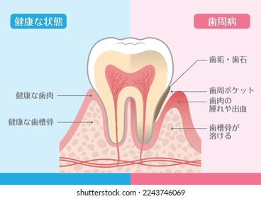 Tooth illustration _ periodontal disease

In Japanese, it says "healthy condition", "periodontal disease", "healthy gums", "plaque", "tartar", "periodontal pocket", "swelling and bleeding".