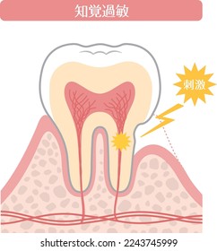 Tooth illustration_Hypersensitivity

There is a description in Japanese of "hypersensitivity" and "irritation".