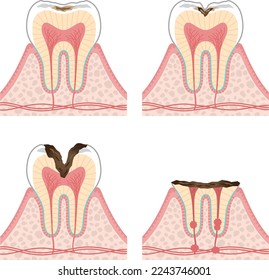 Tooth illustration_progression of tooth decay