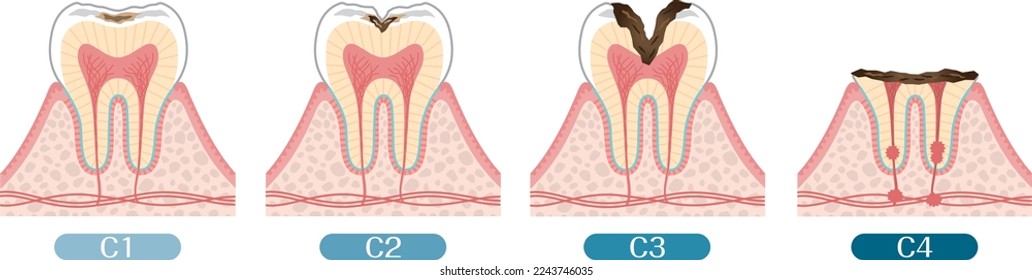 Tooth illustration_progression of tooth decay