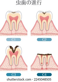 Ilustración dental_progresión de la caries dental

Hay una descripción en japonés de "progresión de caries".