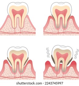 Tooth illustration_progression of periodontal disease