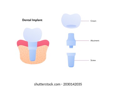 Tooth implant chart. Vector biomedical illustration. Cross section. Teeth prosthesis scheme isolated on white background. Design for dental oral healthcare, dentistry