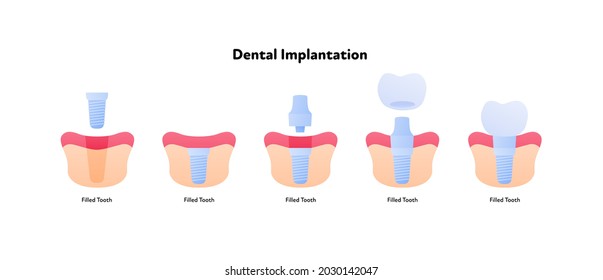 Tooth implant chart. Vector biomedical illustration. Cross section. Teeth prosthesis implantation steps isolated on white background. Design for dental oral healthcare, dentistry