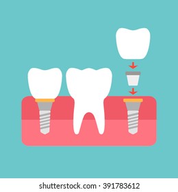 Tooth implant healthy icon vector silhouette. 