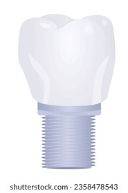 Tooth implant model. vector illustration