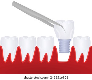 Tooth implant model. vector illustration