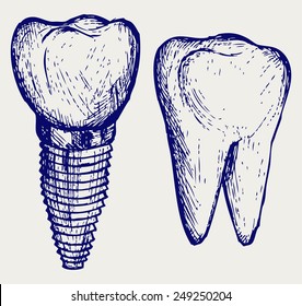 Tooth implant and molar. Doodle style