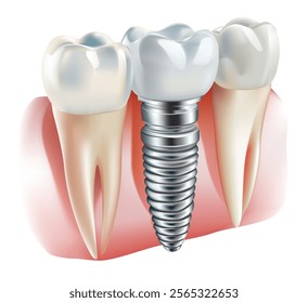 Tooth implant, tooth restoration, on white background, Vector illustration