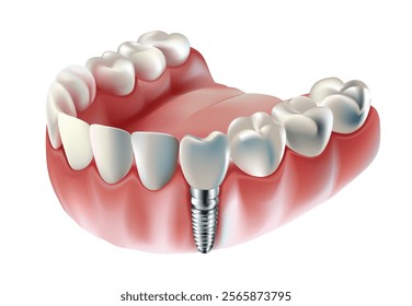 Tooth implant, tooth restoration, on white background, Vector illustration