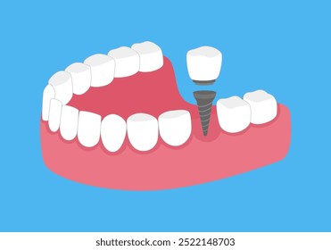 Parafuso de implante dentário em goma ilustração vetor design plana.