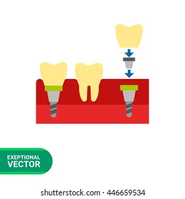 Tooth Implant Vector Icon