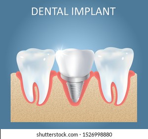 Tooth implant vector medical education anatomy poster template. Human teeth and dental implant with crown attached between them. Dental implantation of artificial root concept.