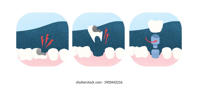 Implantación dental. Implante. Concepto de dentística y ortopedia.